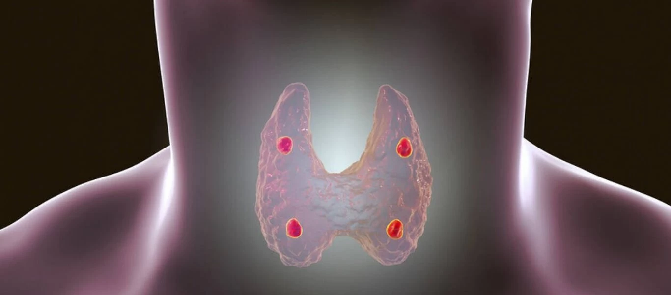 Υποθυρεοειδισμός: Δείτε ποιες είναι οι τροφές που πρέπει να τρώτε & ποιες όχι